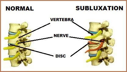 Subluxation comparrison with a normal spine